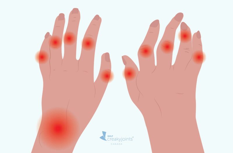 Illustration montrant deux mains souffrant de polyarthrite rhumatoïde. La main gauche est douloureuse mais sans déformation visible. La main droite est douloureuse et des déformations sont visibles
